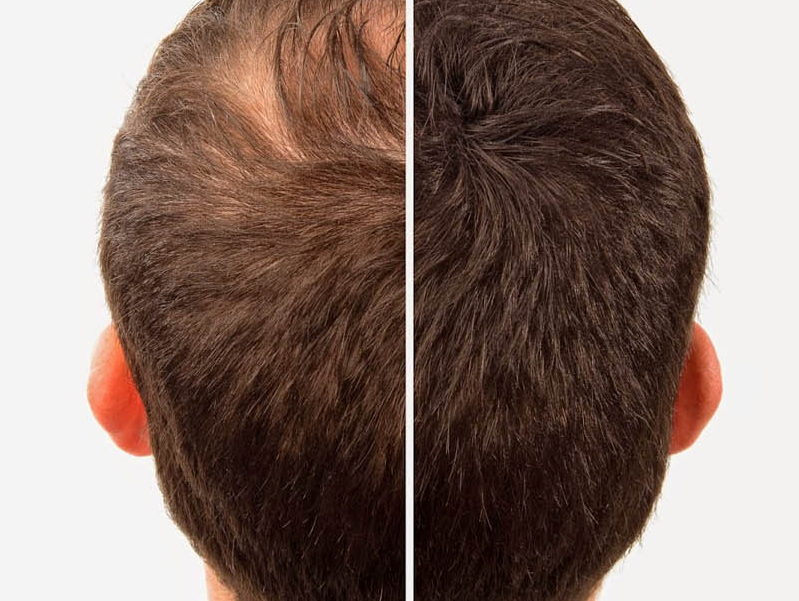 PRP for Hair Loss Treatments