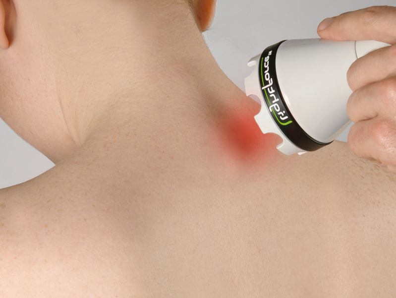 chest laser hair removal treatment